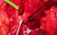 Posterior Urethroplasty after Radiation Treatment for Prostate Cancer 