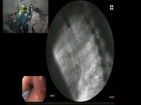 Esophageal Stent Procedure