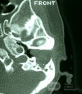 Automastoidectomy secondary to Keratosis Obturans [CT Scan]
