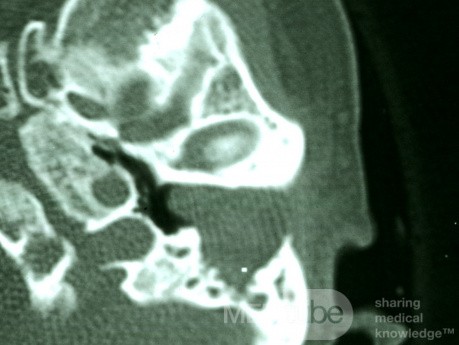 Automastoidectomy secondary to Keratosis Obturans [CT Scan]