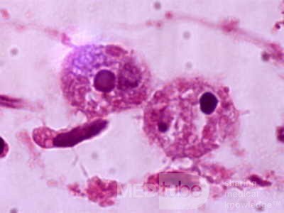Close up of trophozoites of E. histolytica showing the
 nuclear appearance and erythrophagocytosis.

 