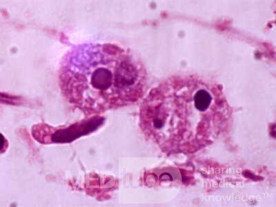 Close up of trophozoites of E. histolytica showing the
 nuclear appearance and erythrophagocytosis.

 
