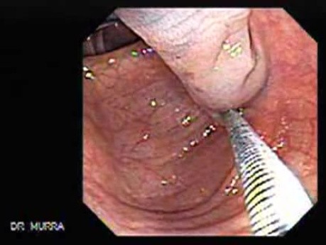Colonoscopic Polypectomy (9 of 23)