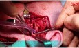 Total Alloplastic Temporomandibular Joint Replacement