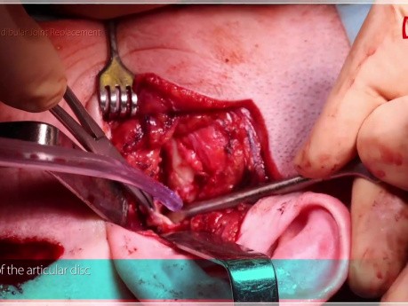Total Alloplastic Temporomandibular Joint Replacement