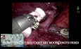 Robotic Surgery for Intralobar Sequestration (Left S6+10 Segmentectomy)