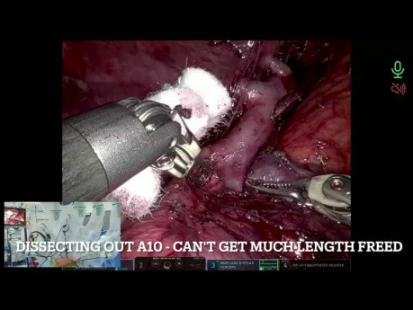 Robotic Surgery for Intralobar Sequestration (Left S6+10 Segmentectomy)
