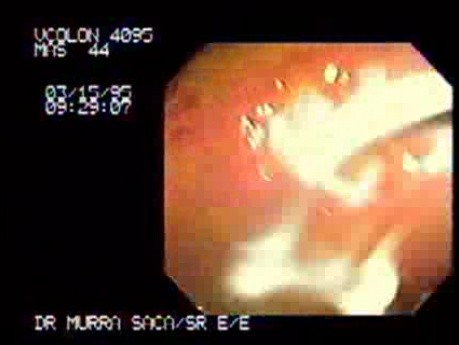Flask Shaped Ulcer