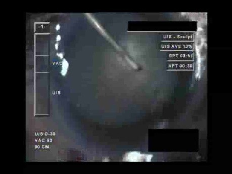 Cataract Surgery X - Part 1