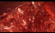 Laparoscopic Left Lateral Sectionectomy for Huge FNH