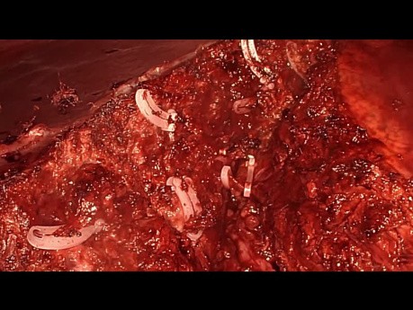 Laparoscopic Left Lateral Sectionectomy for Huge FNH