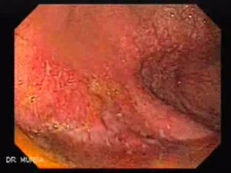 Multiple Rectal Ulcers (18 of 110)