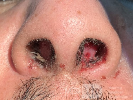 Post Traumatic Septal Hematoma