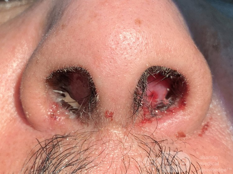 Post Traumatic Septal Hematoma