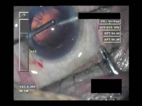 Cataract Surgery 2 - Part 3