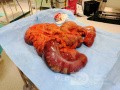 Constipation as a Cause of Megacolon and Multiorgan Failure