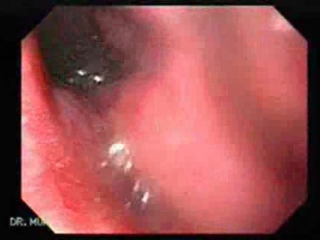 Adenocarcinoma of the Gastroesophageal Junction - Endoscopic Passage Through the Fistula 