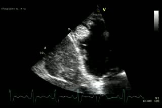 Big Right Ventricul Thrombus  DCM