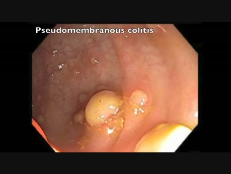 Colonoscopy Channel - Pseudomembranous Colitis