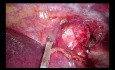 Advanced VATS Instrumentation: Lymph node dissection (NO EDITION)