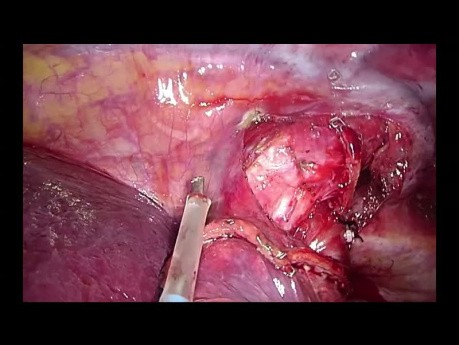 Advanced VATS Instrumentation: Lymph node dissection (NO EDITION)