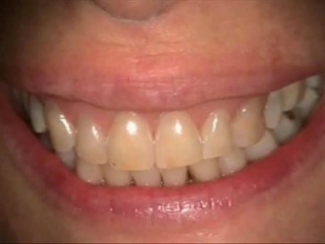 The Case Of The Missing Papillae, Part Deux