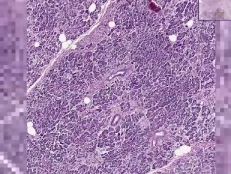 Pancreas - Adenocarcinoma