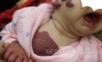 Hemangioma