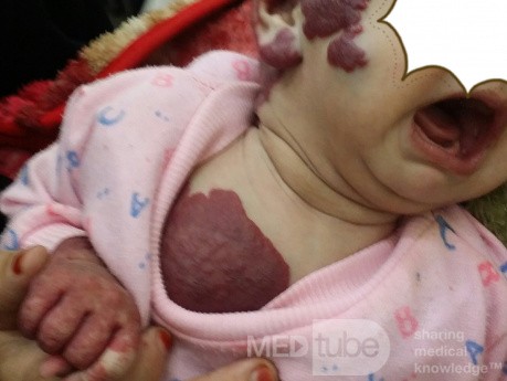 Hemangioma