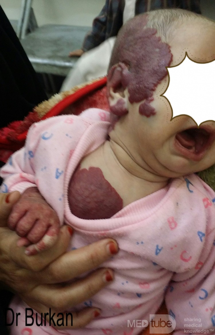Hemangioma