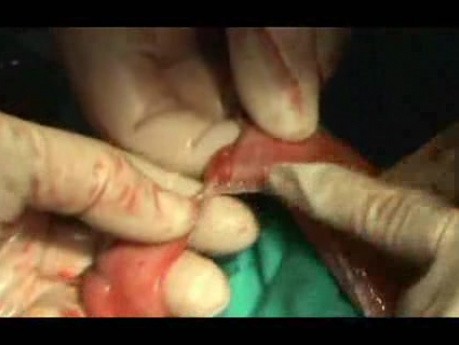 Barrett Adenocarcinoma - Therapeutic Endoscopy (7 of 7)