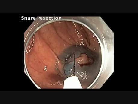 Colonoscopy Channel - How To Perform EMR 1