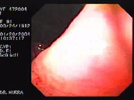 Giant Gastric Ulcer - Endoscopy (4 of 5)