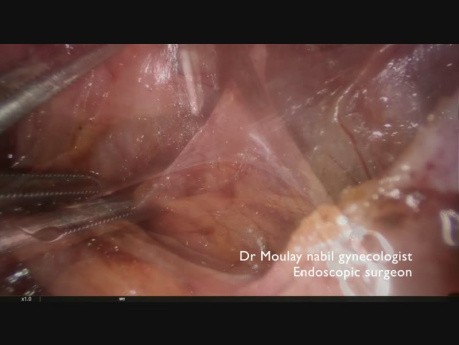 Bladder, Utero Sacral, Recto Vaginal Deep Infliltrating Endometriosis