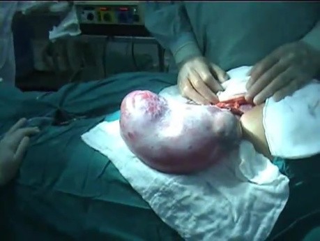 A Case of Benign Ovarian tumors Associated With Pregnancy