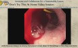 Aortic Occlusion Balloon to Achieve Hemostasis in Acute Upper GI Hemorrhage: A Mini-Video Case