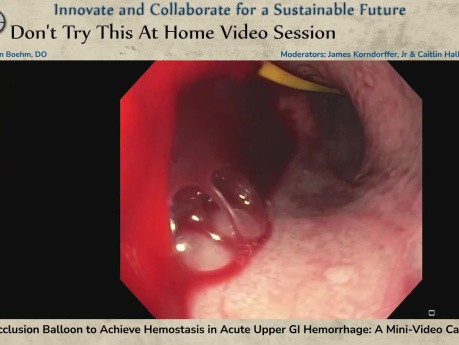 Aortic Occlusion Balloon to Achieve Hemostasis in Acute Upper GI Hemorrhage: A Mini-Video Case