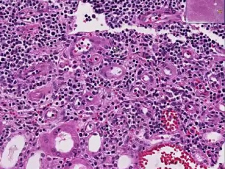Acute transplant rejection - Histopathology - Kidney