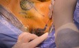 Endoscopic Retro-auricular (Facelift Incision) Approach to Hemithyroidectomy for Benign Solitary Thyroid Nodule