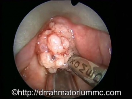 The Use of Microdebrider for Laryngeal Papillomatosis Removal