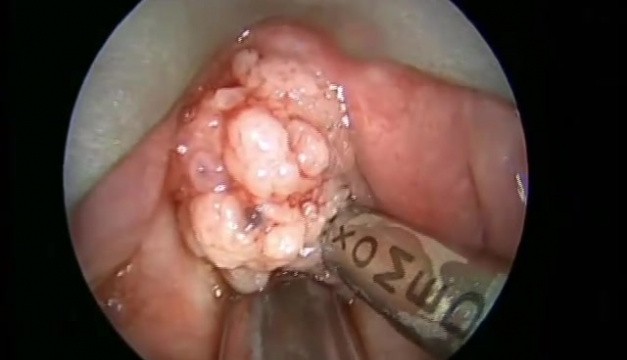 laryngeal papillomatosis uptodate