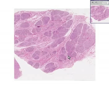 Breast - Hyperplasia Of Pregnancy