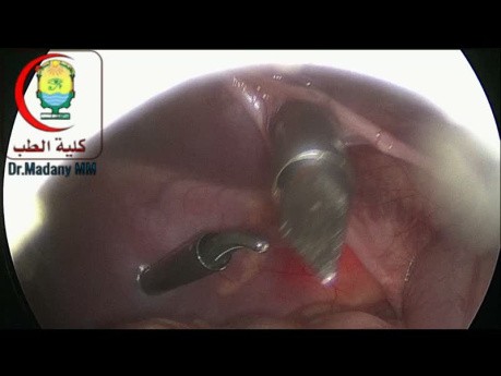 Large Redundant Medial Umbilical Ligaments