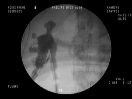 PCNL - Complications
