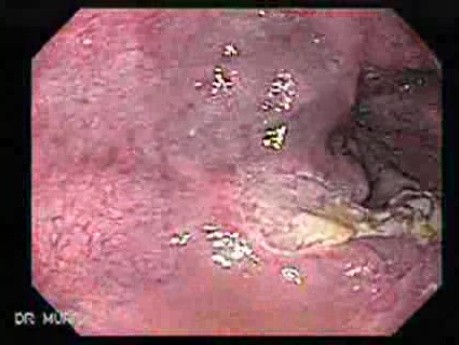 Long Standing Alcohol Abuse - Shallow Ulcers Post Ligation