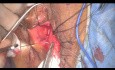 Partial Urethrectomy, Female Urethroplasty, Rare Oncology Case
