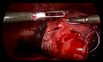 Laparoscopic Liver Resection of Segments 2, 3, 6 and 7