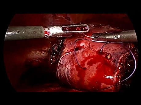 Laparoscopic Liver Resection of Segments 2, 3, 6 and 7