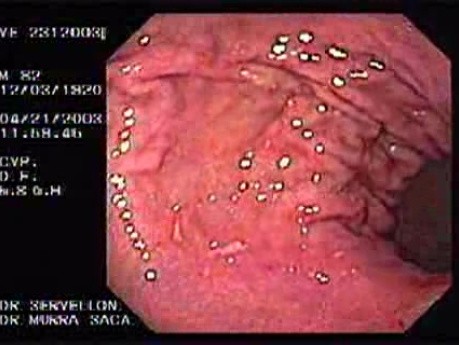Acute Bleeding - Closer Look at the Source, Part 1