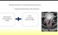 Standardized Robotic Lateral Pelvic Lymph Node Dissection for Advanced Rectal Cancer